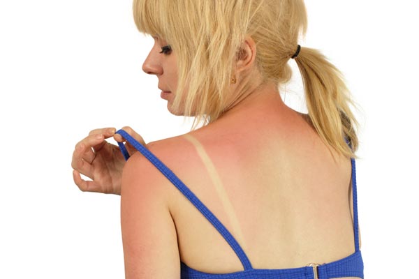 Scottature solari, come alleviarle con i rimedi naturali