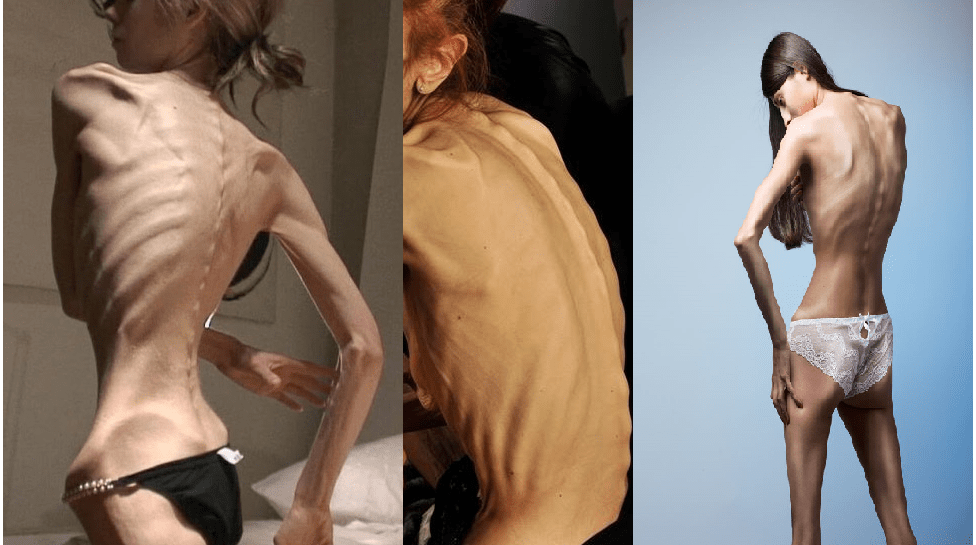 Blog Pro Anoressia: l’assurdità della malattia che viaggia in rete