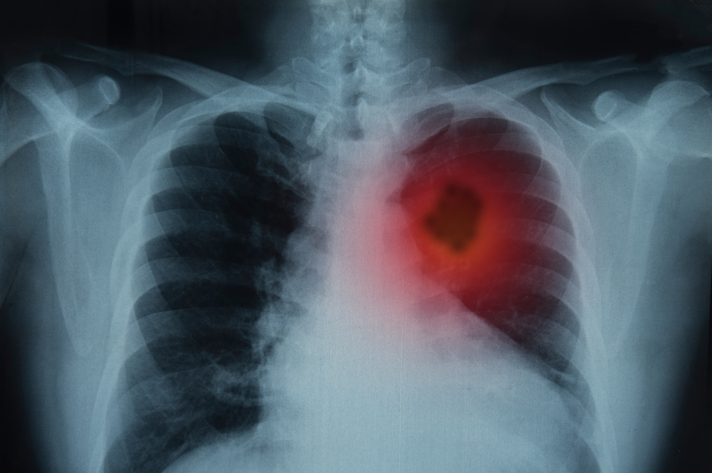 Roman, il bimbo di 2 mesi con un cancro rarissimo: diagnosticato solo 88 volte in tutto il mondo