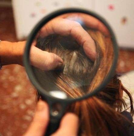 Cura dei capelli: i pidocchi