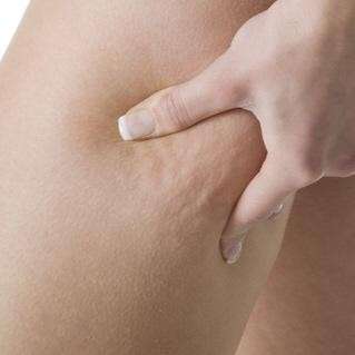 cellulite