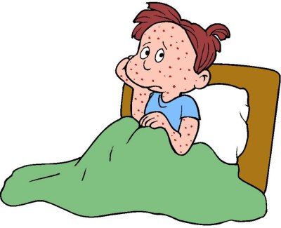 Varicella bambini: quali sono i sintomi e il decorso