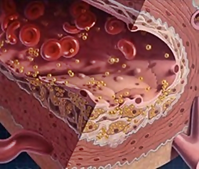 Arteriosclerosi: arriva il vaccino