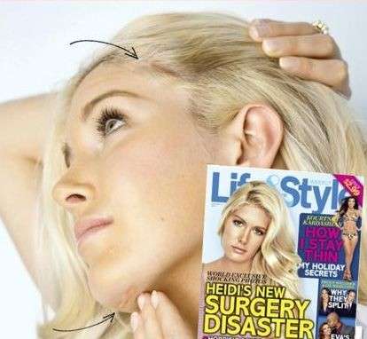 Heidi Montag: i disastri dopo la chiururgia estetica