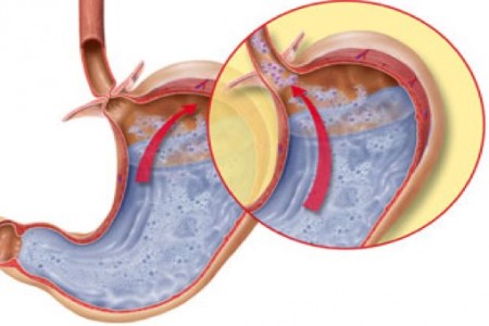 Reflusso gastroesofageo: sintomi e dieta da seguire