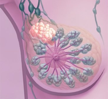 Tumore al seno: bloccare una proteina per fermarlo