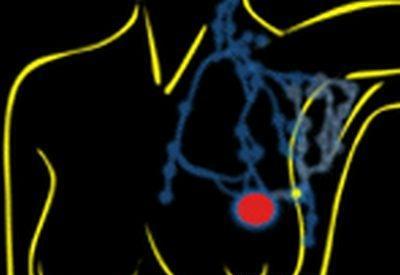 Tumore al seno: dalla diagnosi alla terapia, un unico percorso