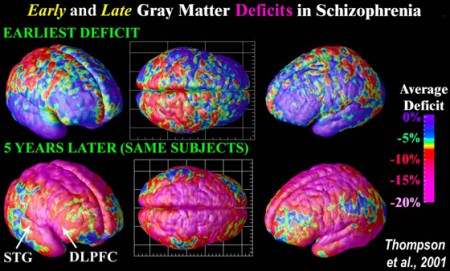 Cervello: schizofrenia ricreata in laboratorio