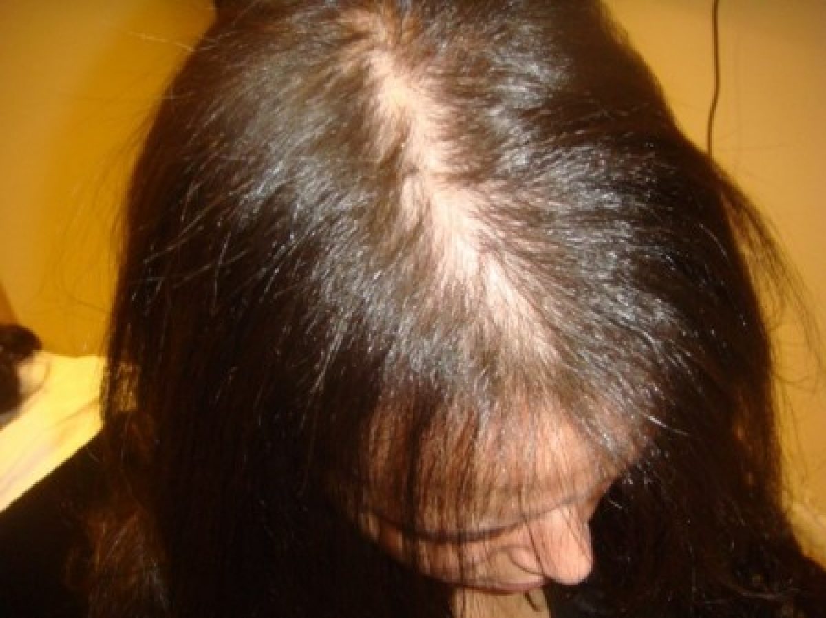 Выпадают волосы у женщины сильно на голове. Диффузная и андрогенная алопеция. Диффузная телогеновая алопеция. Рубцовая андрогенетическая алопеция.