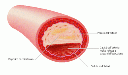 Colesterolo: scoperta una variante più “cattiva”