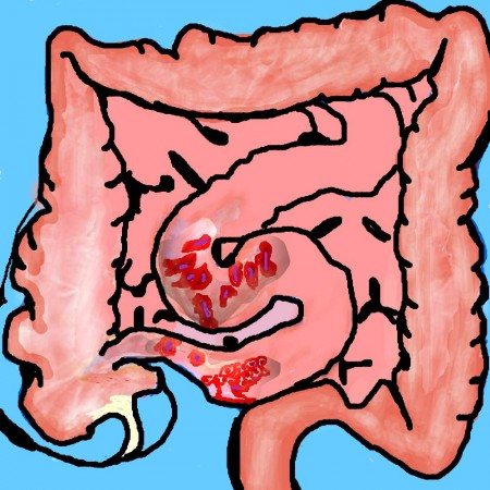 Morbo di Crohn