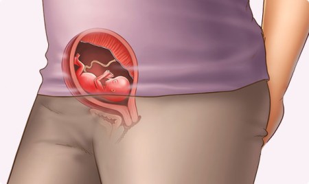 Utero retroverso: cosa comporta e come avere una gravidanza