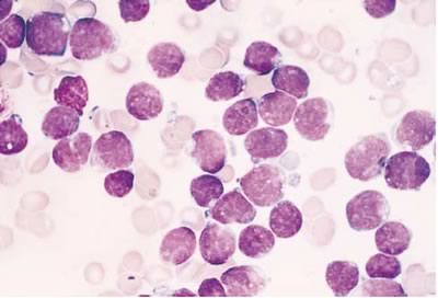 Contro la leucemia infantile scoperta una potente molecola