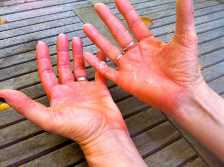 Perché esiste il disturbo delle mani rosse e quali sono i rimedi