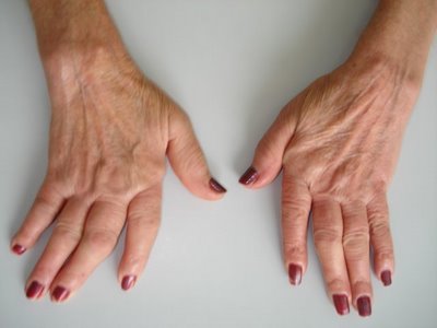 L’artrite reumatoide colpisce anche le giovani donne