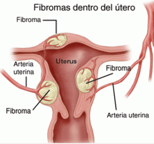 Come riconoscere i sintomi dei fibromi uterini