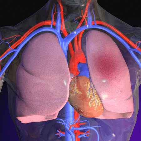 Embolia polmonare, sintomi da riconoscere e primo intervento