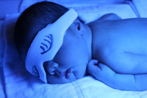 L’ittero nei neonati e nei bambini, cause e cure