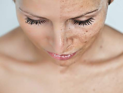 Macchie della pelle, come eliminarle con trattamenti estetici e rimedi naturali