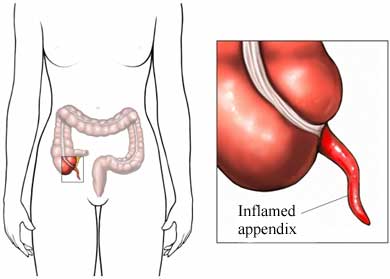 Appendicite, quali sono le cause e i sintomi caratteristici