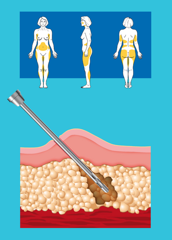 Liposuzione danni