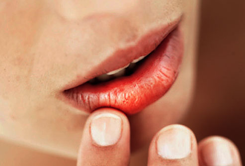 Labbra screpolate: cause e rimedi naturali più efficaci