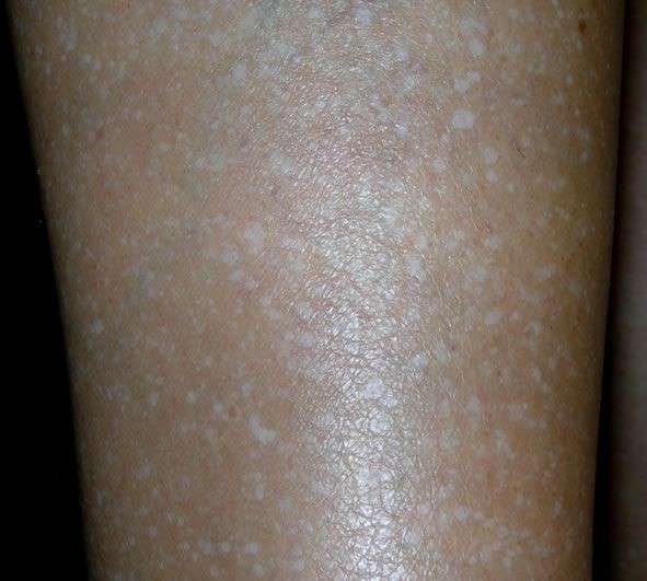 Macchie bianche della pelle: le cause e i rimedi [FOTO]