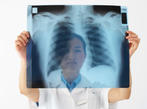Tumore al polmone: sintomi, stadi e diagnosi