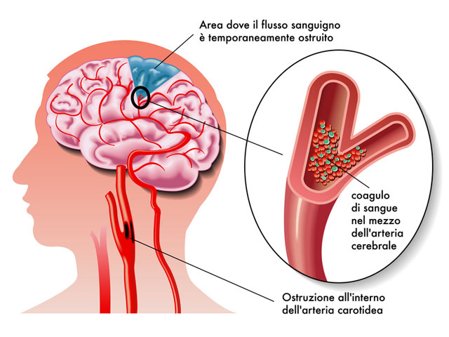 Ictus
