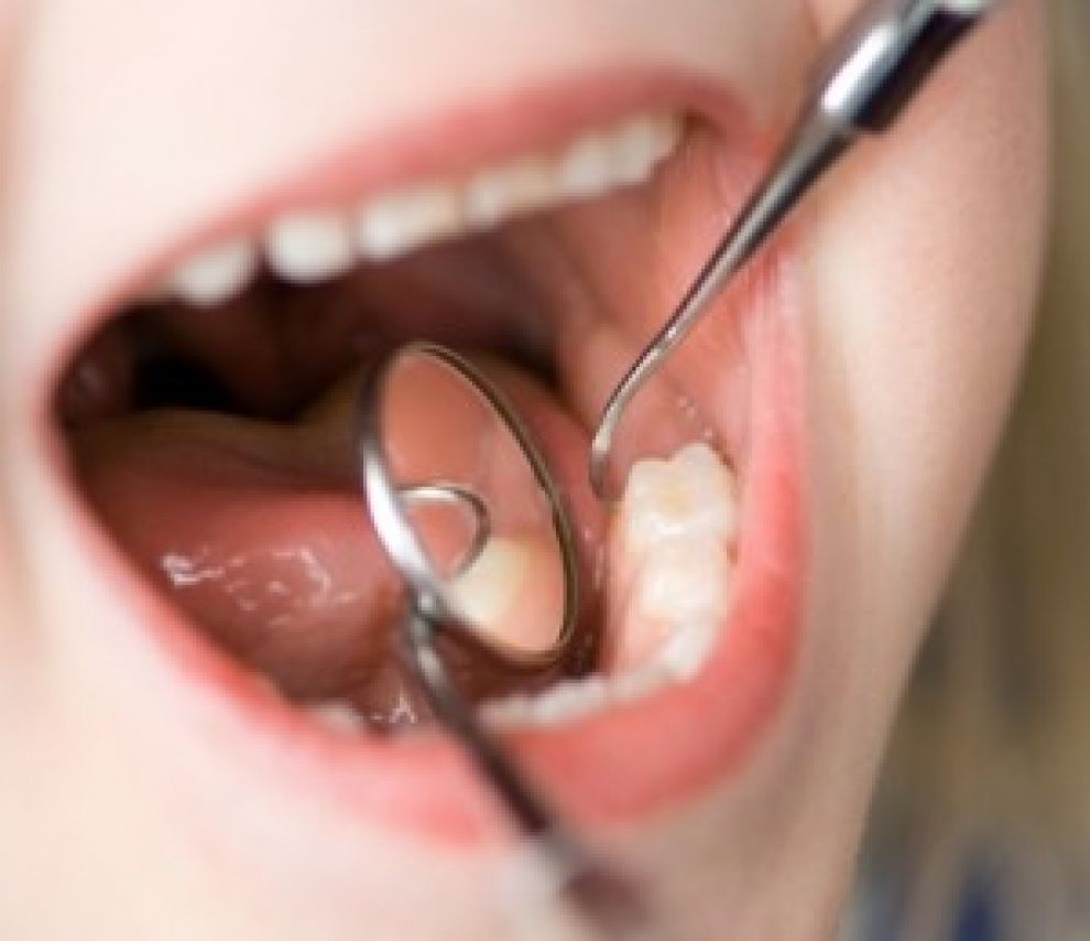 Parodontite nei bambini: sintomi, cause e rimedi