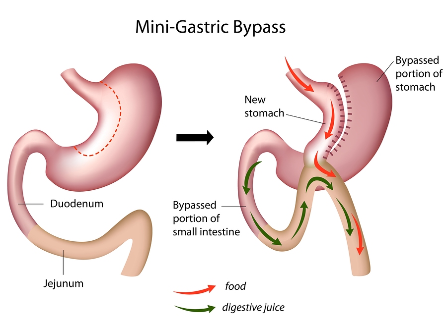 Bypass gastrico per dimagrire: come funziona?