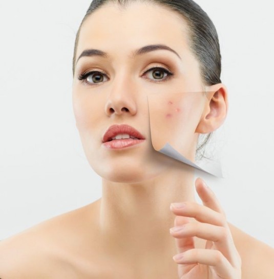 Acne negli adulti: cause, cure e rimedi naturali