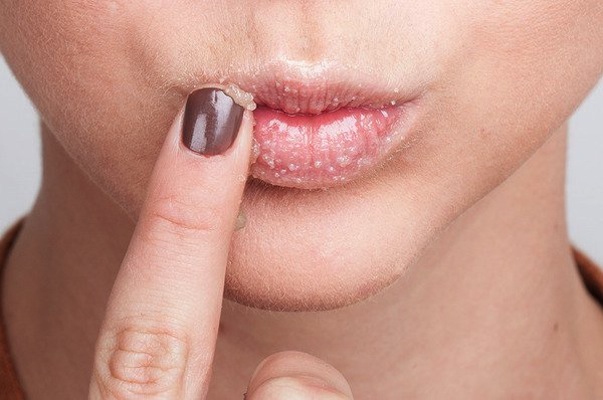 10 rimedi naturali per labbra screpolate