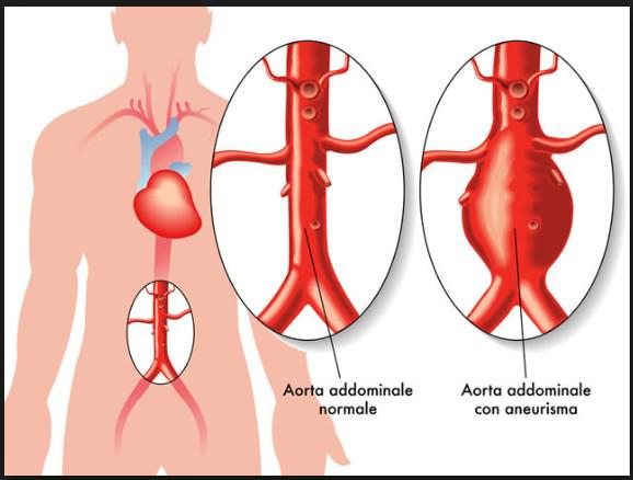 Aneurisma: sintomi, diagnosi e cure