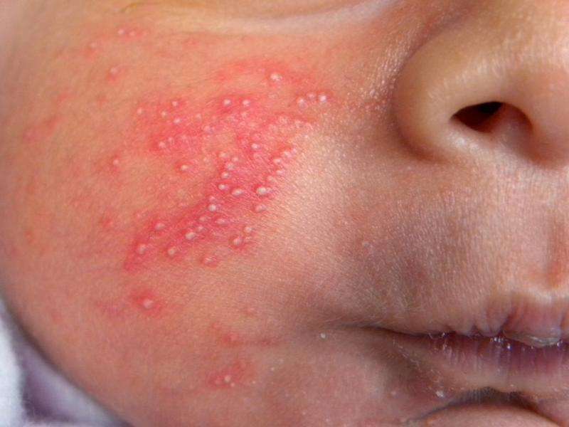 Sudamina nei bambini: rimedi naturali e immagini per riconoscerla [FOTO]
