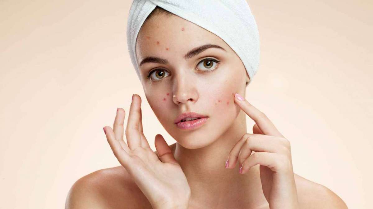 Prodotti bio per l’acne: i migliori da provare per una pelle perfetta [FOTO]