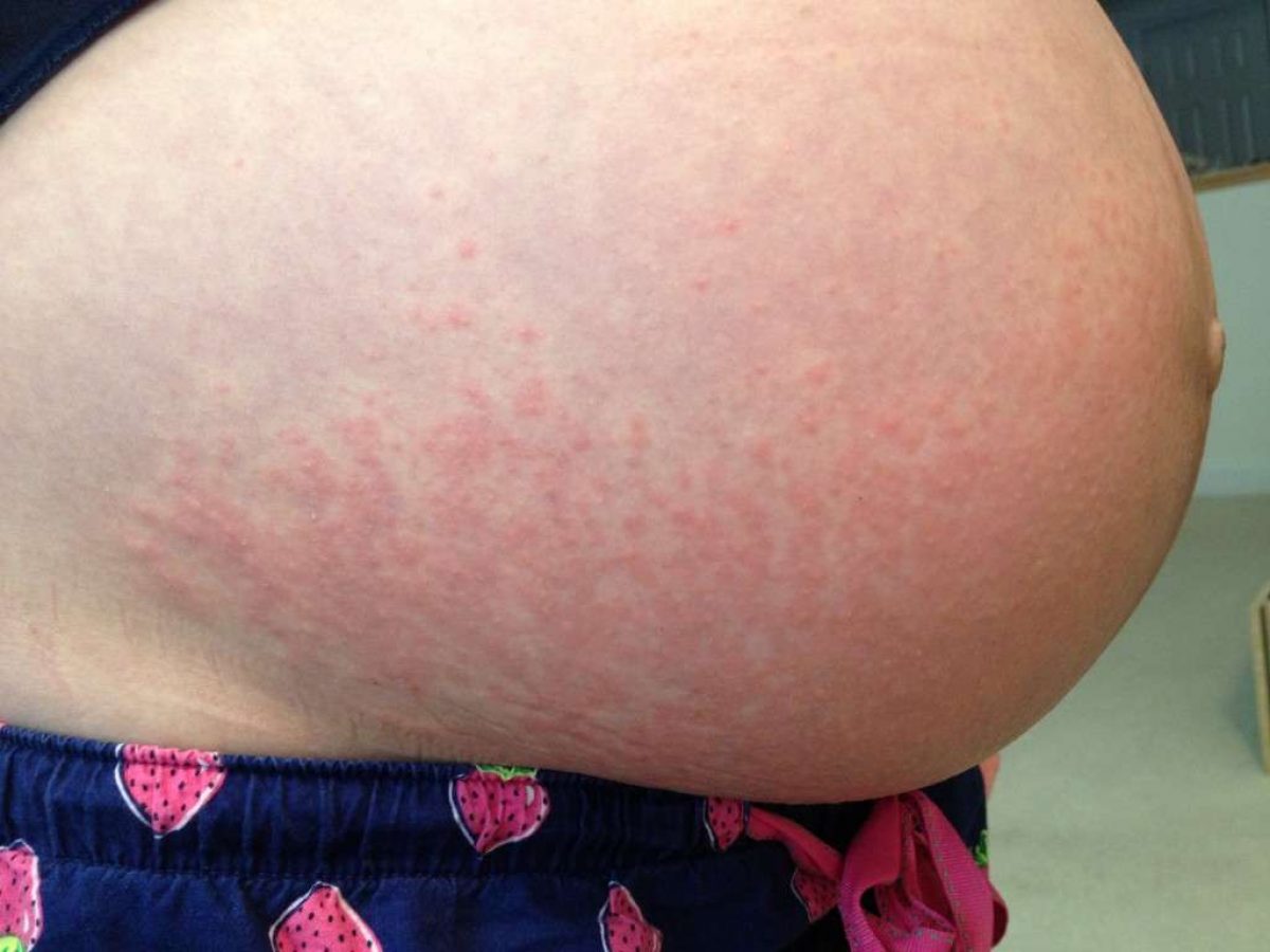 аллергия на груди у беременной фото 1
