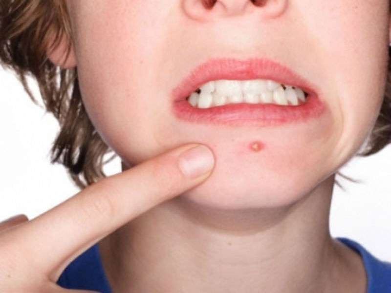 Acne cistica: cause, come curarla e rimedi naturali