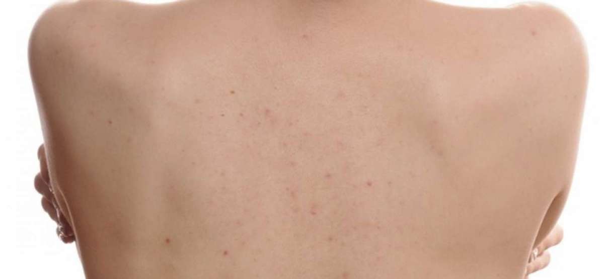 Acne estiva o acne di Maiorca: rimedi naturali e terapia