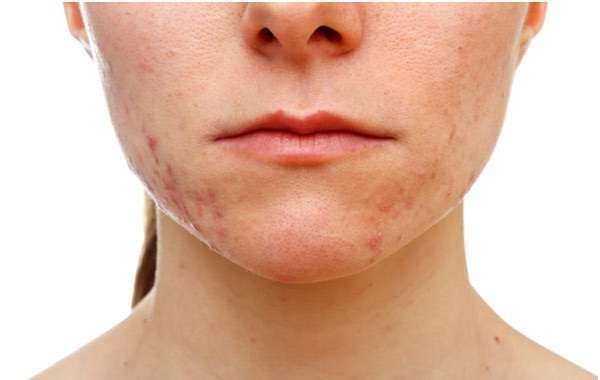 Acne ormonale: come riconoscerla, cure e rimedi