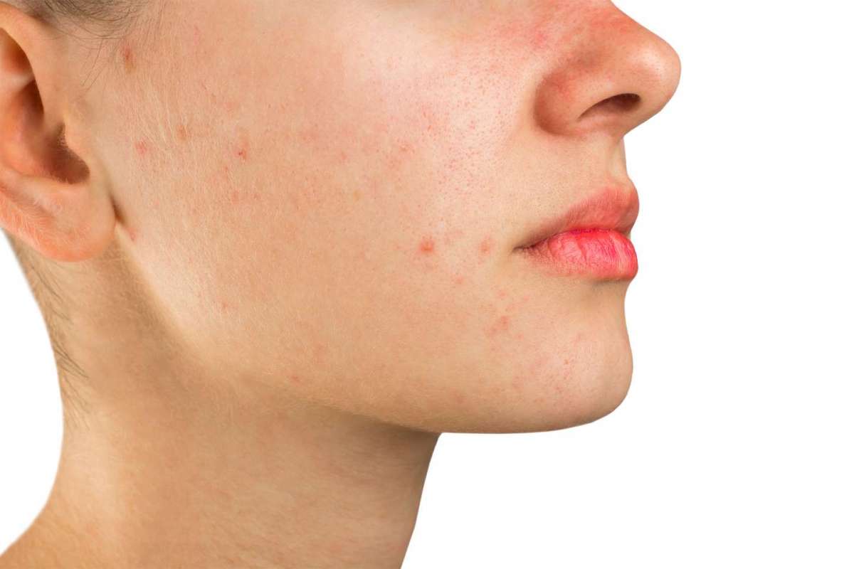 Acne rosacea: cause, cure, rimedi naturali e alimentazione