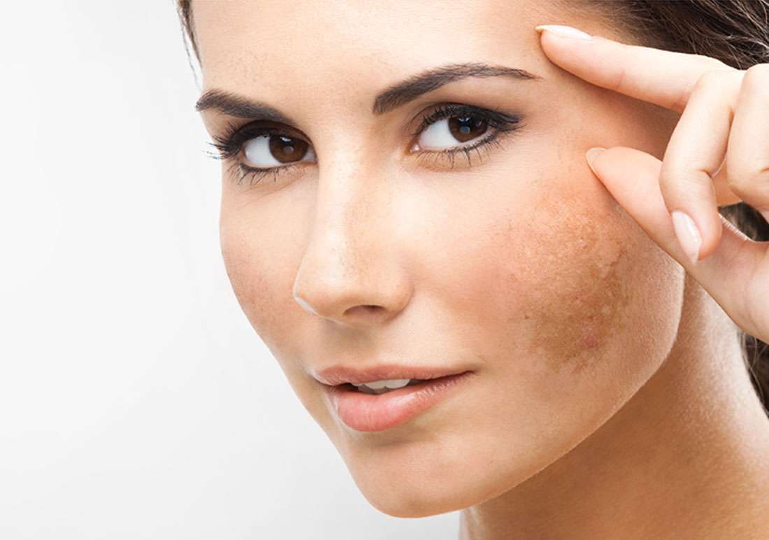 Melasma: cause, cure e rimedi naturali