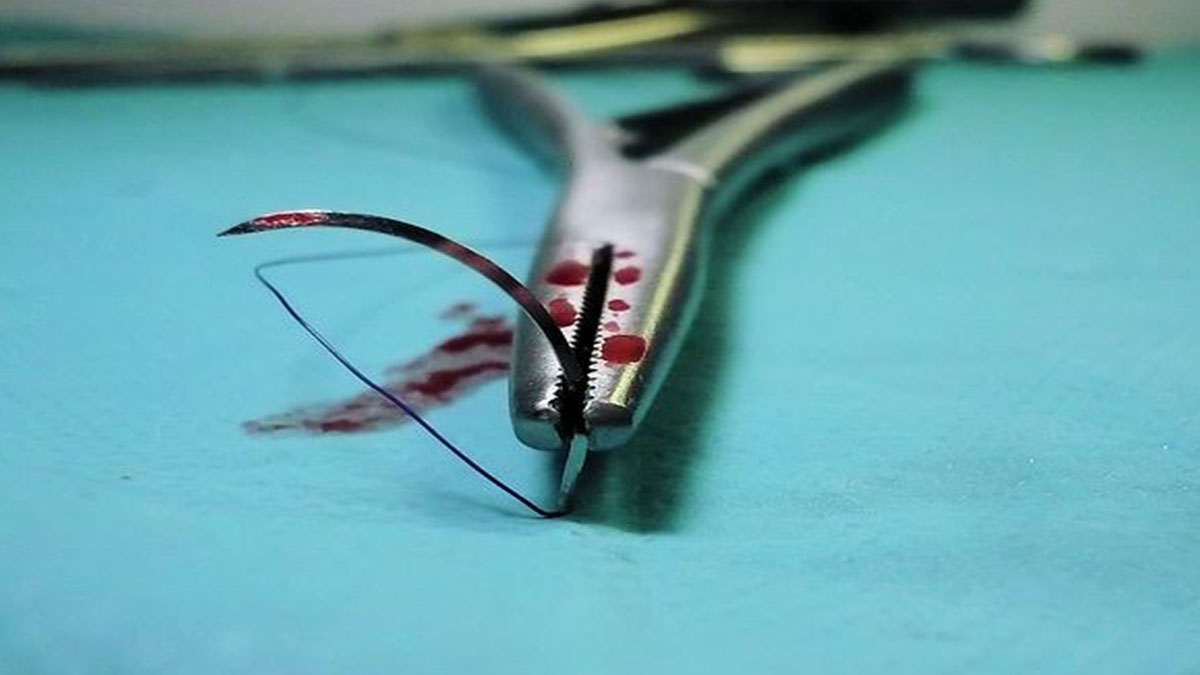 Venezia, cuore lesionato durante l’intervento: donna muore in sala operatoria