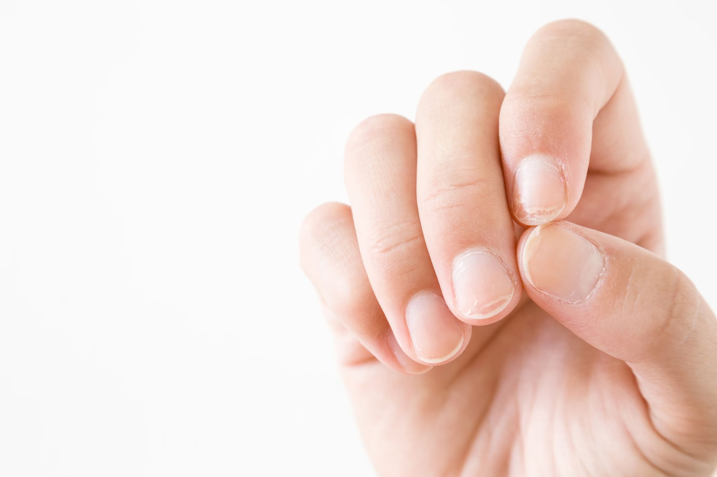 Psoriasi alle unghie: immagini, cure e rimedi
