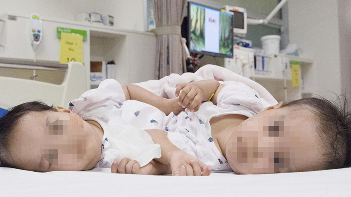 Melbourne: gemelline siamesi separate grazie a un intervento di sei ore