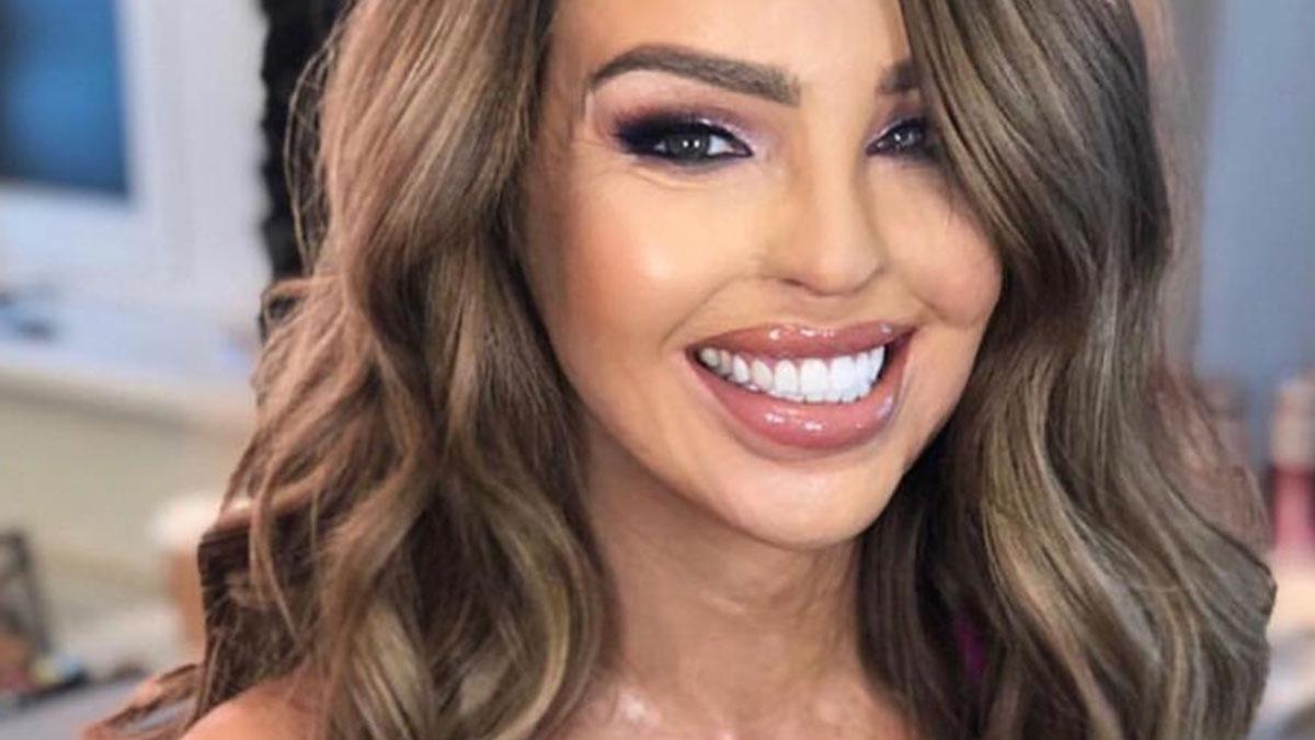 #10YearsChallenge: la modella Katie Piper condivide il recupero dopo l’attacco con l’acido