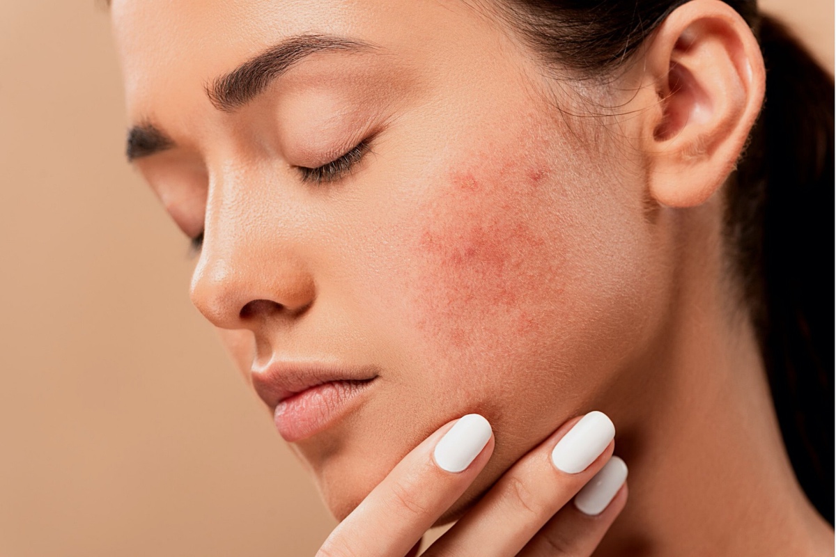 Acne Skin Purging