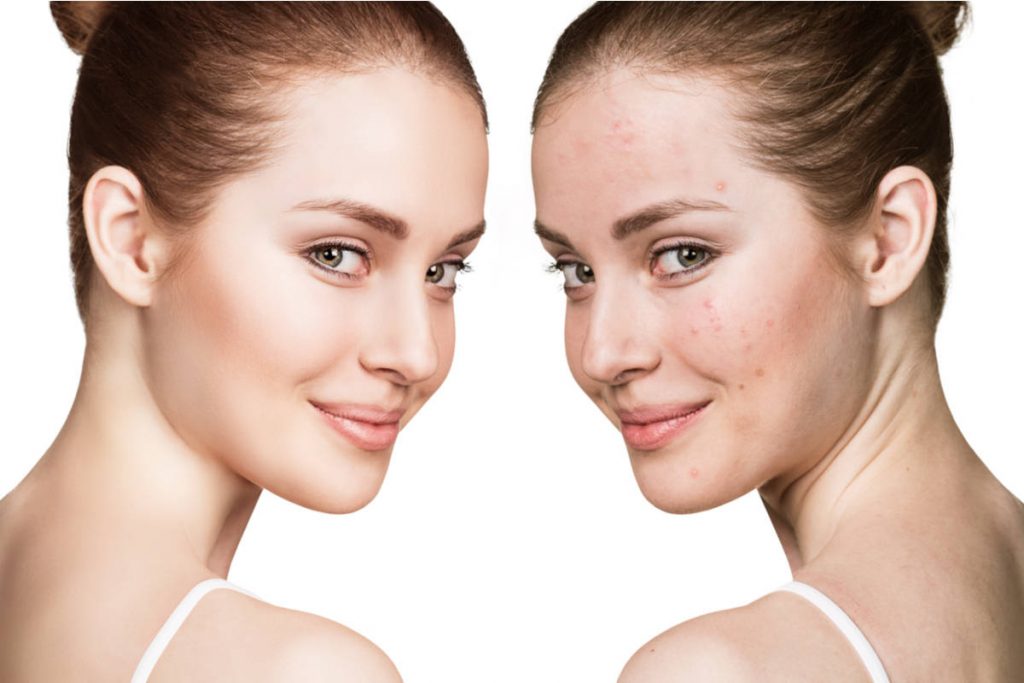 Macchie acne prima e dopo