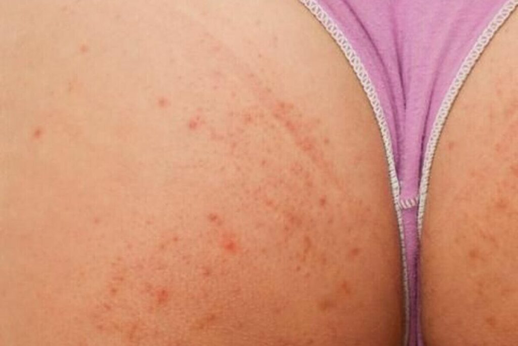 esempio acne lato b - follicolite