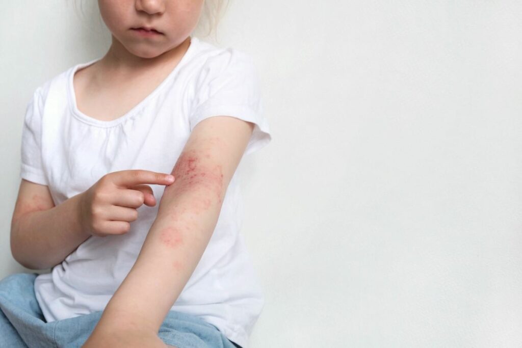 Bambina con dermatite sul braccio sinistro